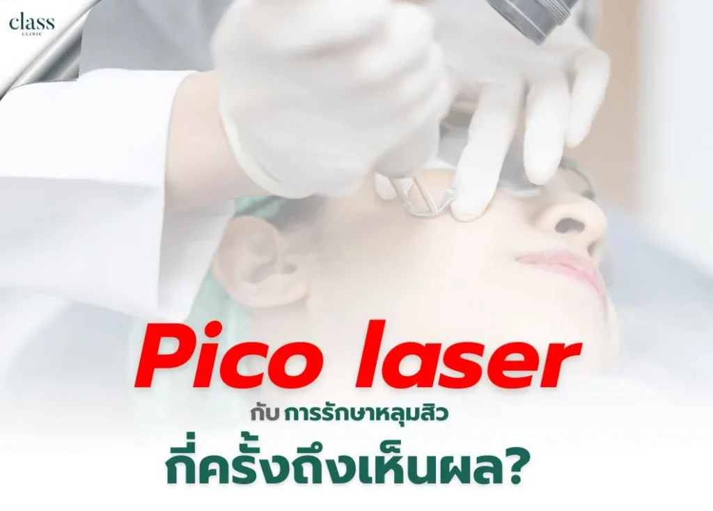 Pico Laser กับการรักษาหลุมสิว ใช้เวลากี่ครั้งถึงเห็นผล