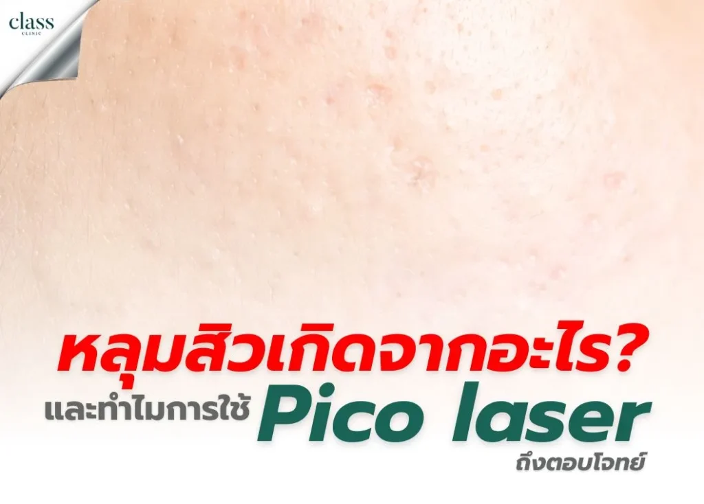 หลุมสิวเกิดจากอะไร และทำไมการใช้เลเซอร์ Pico ถึงตอบโจทย์