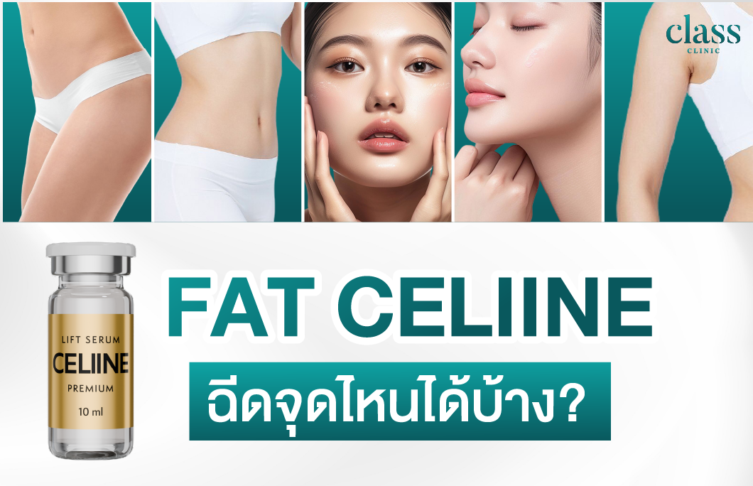 Fat CELIINE ฉีดจุดไหนได้บ้าง?