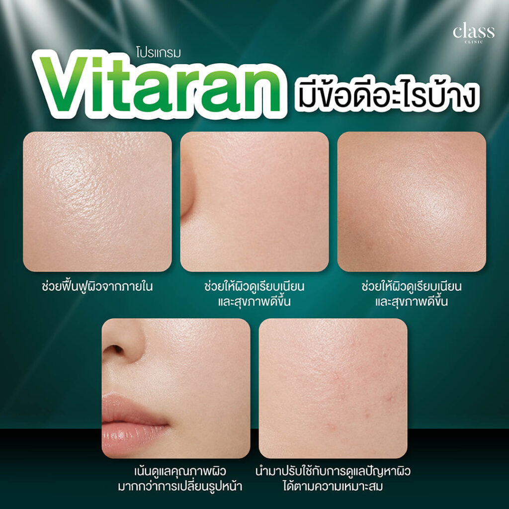 Vitaran มีข้อดีอะไรบ้าง