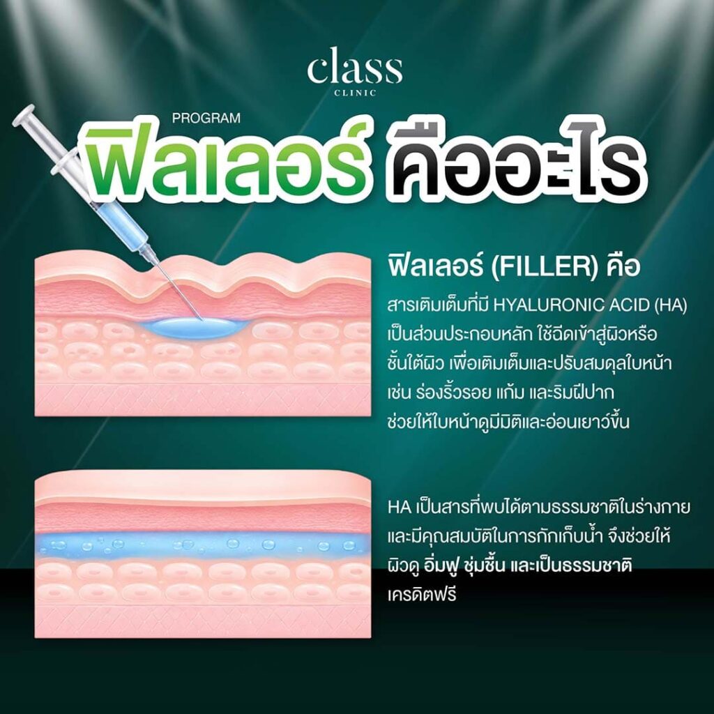 ฟิลเลอร์ คืออะไร