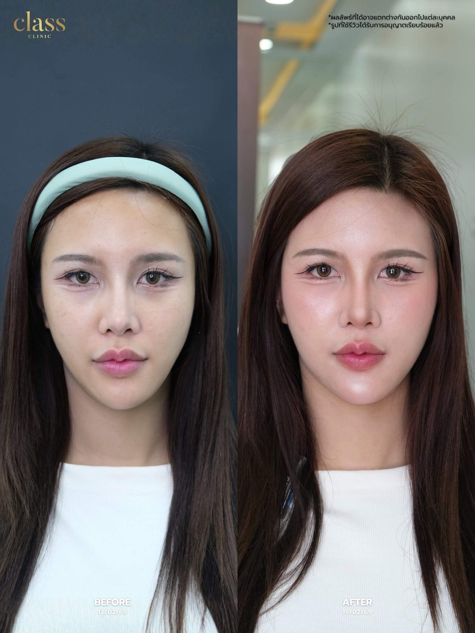 รีวิวโปรแกรม REGENE
