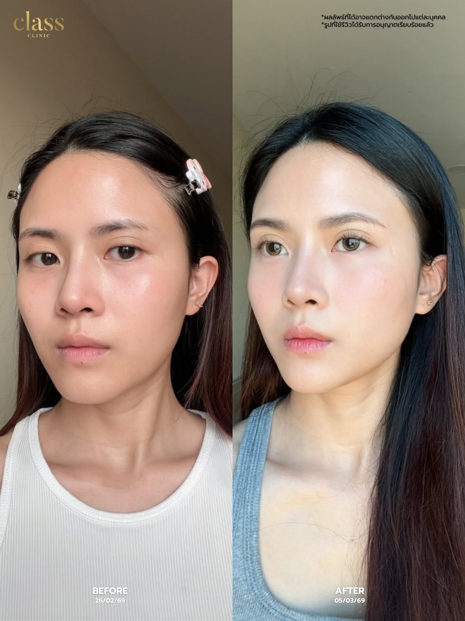 รีวิวโปรแกรม REGENE