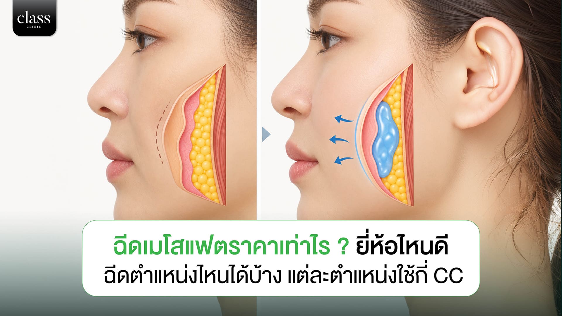 ฉีดเมโสแฟตราคาเท่าไร ? ยี่ห้อไหนดี ฉีดตำแหน่งไหนได้บ้าง แต่ละตำแหน่งใช้กี่ CC